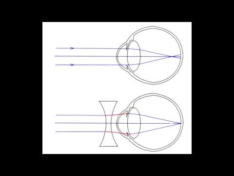 myopia hyperopia mnemonic