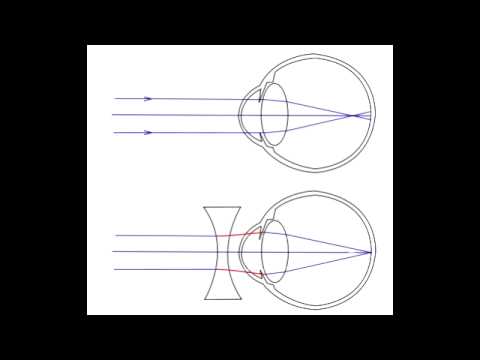 hyperopia myopia astigmatizmus