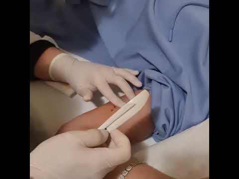 Vídeo: 3 maneiras de remover Nexplanon