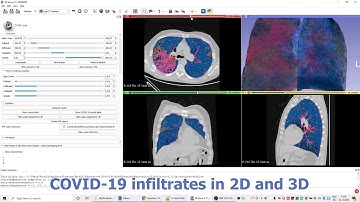 Volumetric COVID-19 lung CT analysis with 3D Slicer