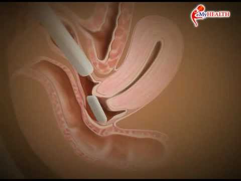 Video: Cara Menggunakan Krim Progesteron untuk PMS: 12 Langkah (dengan Gambar)