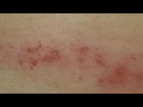 Rash Early Stage Scabies Images