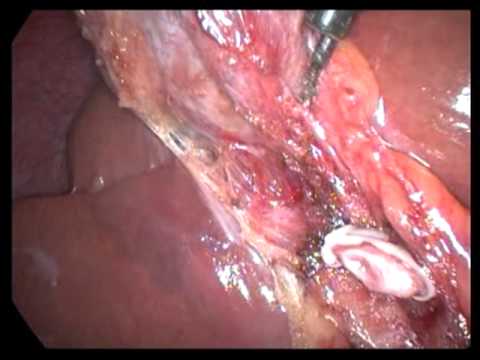 Laparoscopic Cholecystectomy (unedited-24)-In Chronic Cholecystitis With Considerable Omental Adhesi