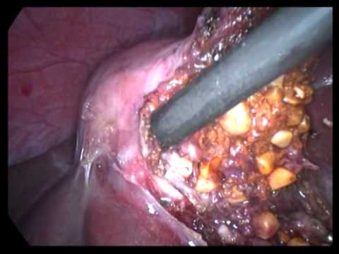 Lap. Cholecystectomy (unedited-168)-Stone Packed GB-spillage Management