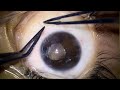 Live Surgical Demonstration: Cataract Surgery Featuring NANEX IOL – Dr Gaurav Luthra