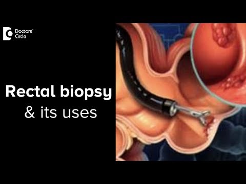 How is a rectal biopsy done? Why is it necessary? - Dr. Rajasekhar M R