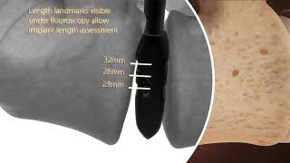 Medtronic | Sistema de Columna: Elevate
