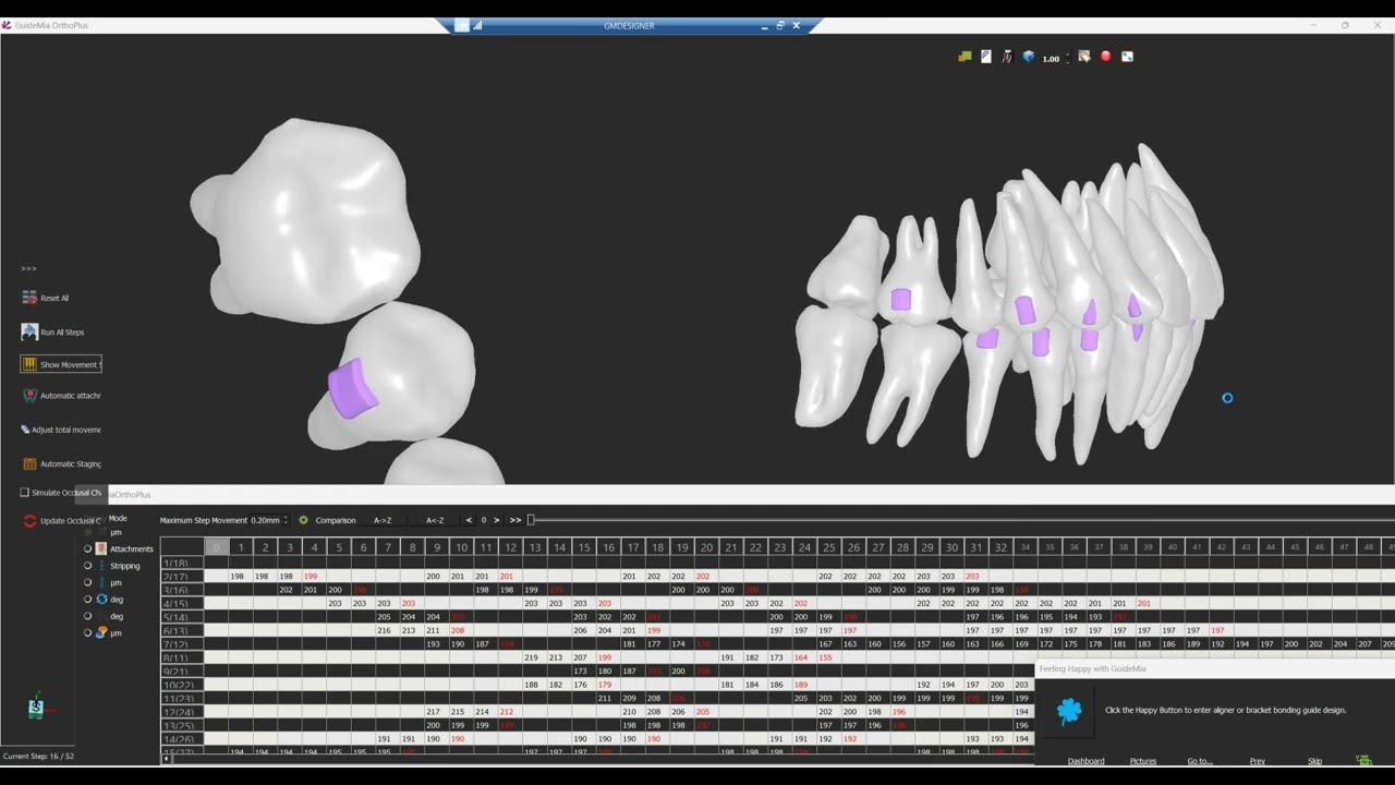 OrthoPlus Full Workflow with CBCT