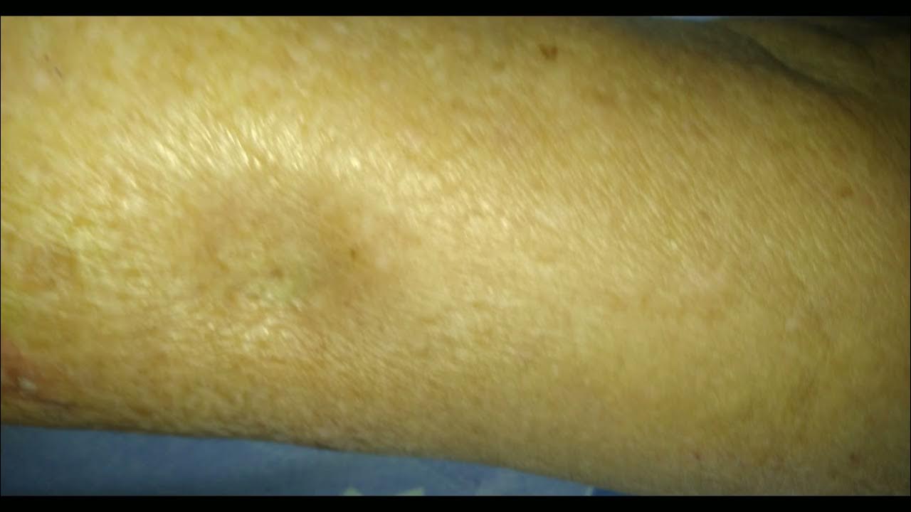 Leg Swelling How to Check the Grades of Pedal Edema Pedaledema imwell legswelling YouTube