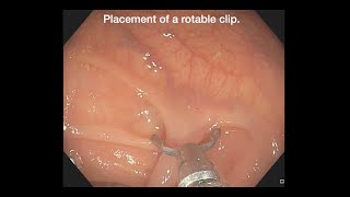 Ligation of a pedunculated polyp with clips