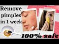 #acnefreeskin | REMOVE PIMPLES IN 1 WEEK | WITH ONLY 2 INGREDIENTS |  100% RESULTS  | FASHION MANTRA