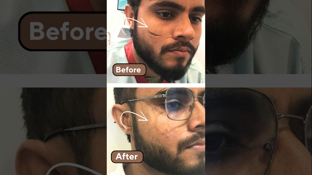 Scar Revision Surgery in Noida | Team of Plastic Surgeons | Scar Revision Before After Result