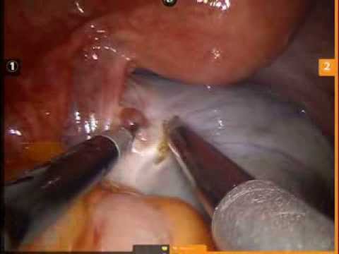 Single Site Robotic Left Ovarian Cystectomy 9 Cm Endometrioma 3 Minutes Single Site Robotic Left Ovarian Cystectomy 9 Cm Endometrioma 3 Minutes