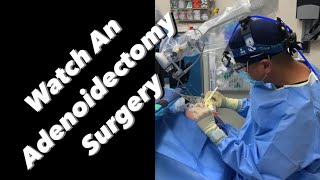 Adenoidectomy - actual footage