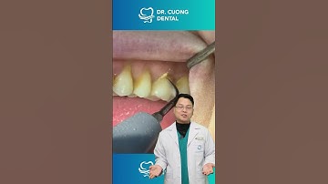 Cao Răng Hàm Thì Phải Làm Sao | Bác sĩ Cường