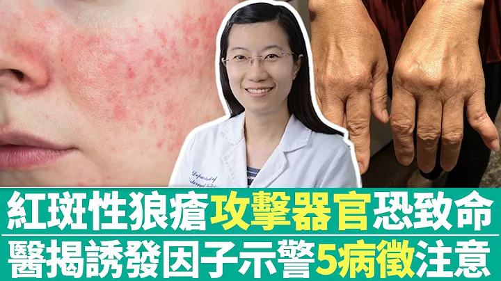 【健康療天室】紅斑性狼瘡「攻擊器官」恐致命　醫揭誘發因子示警「5病徵」注意 @ChinaTimes - 天天要聞