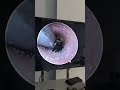 🧼 Sticky Earwax Removed in Seconds! #shorts #earwax #earcare