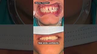 Teeth gap closed permanently #smile #mumbaidental #teethgap #ulwe #navimumbai