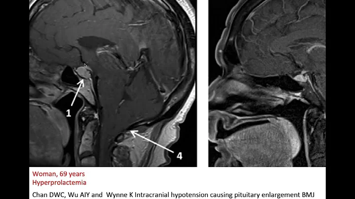 29. Intracranial hypotension; sagging, subdural effusion, headache, brain scan, spinal CSF leak