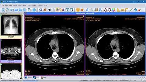 Sante DICOM Viewer - How to compare images of the same series