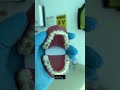Invisalign vs. Braces: Which is Best for Your Smile?