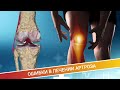 ОШИБКИ В ЛЕЧЕНИИ АРТРОЗА (История пациента)
