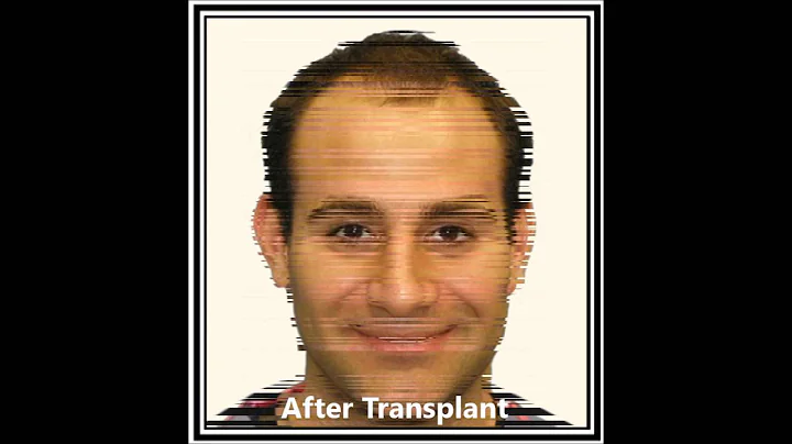 Hair Transplant by Dr. Baldev Sandhu