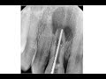 Расширение корневых каналов зубов. На сколько размеров? Понятный алгоритм