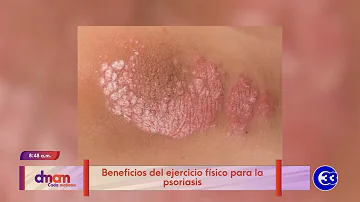 ¿El ejercicio empeora la psoriasis?