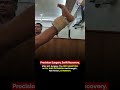 Why Full Knee Extension Is the #1 Goal After ACL Surgery