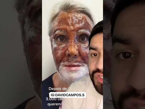 Video: Cómo aplicar una exfoliación con TCA (con imágenes)