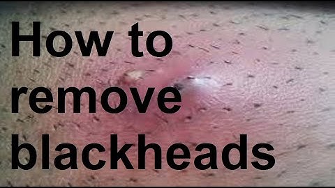 Causes and how to treat blackheads#blackheads