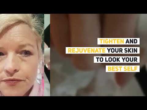 Reduce Wrinkles Ballyclare - Call 07468 694308 - Face Lift, Crows Feet reduction Northern Ireland by Janval Aesthetics