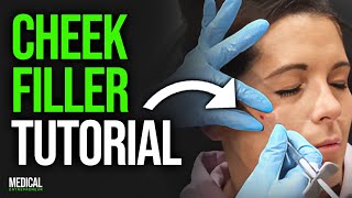 Cheek FIller for the Perfect Mid-Face Lift | Full Procedure Demonstration