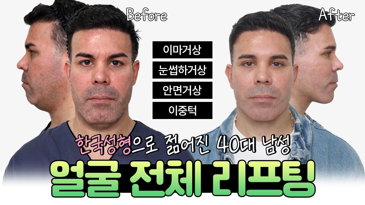 🇵🇷남자턱선과 이중턱 가장 개선하고 싶어요! [이마거상+안면거상+눈썹하거상+이중턱 근육묶기]