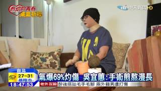 20150703中天新聞　氣爆全身69%燙傷　吳宜蕙活出自我
