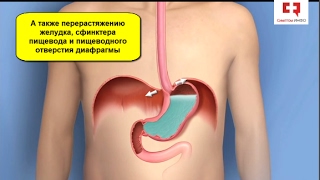 Изжога после еды и ее причины: гастроэзофагеальная рефлюксная болезнь (ГЭРБ) и рефлюкс эзофагит Изжога после еды и ее причины: гастроэзофагеальная рефлюксная болезнь (ГЭРБ) и рефлюкс эзофагит