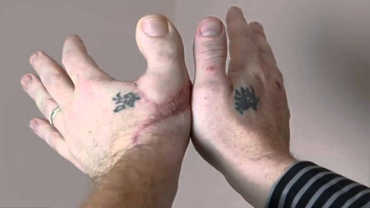 La psoriasis influye el embarazo