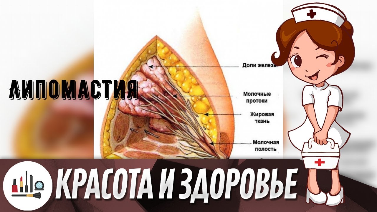 Липомастия - YouTube