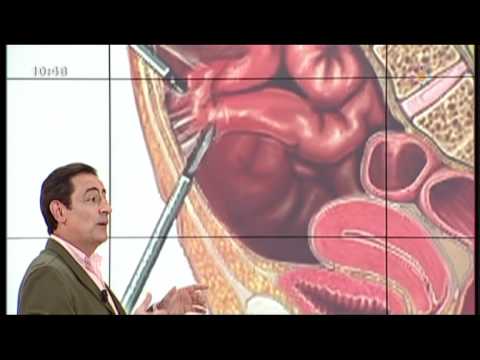 las adherencias abdominales pueden causar dolor pélvico las adherencias abdominales pueden causar dolor pélvico