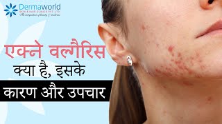 एक्ने वल्गैरिस क्या है, इसके कारण और उपचार | Acne Vulgaris Pimples Causes and Treatment Options