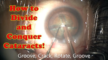 How to Divide and Conquer Cataracts! Chris Teng, MD