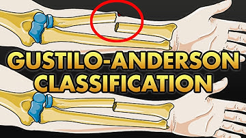 Gustilo Anderson Classification of Open Fractures