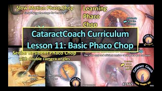 CataractCoach™ 1665: curriculum lesson 11: basic phaco chop