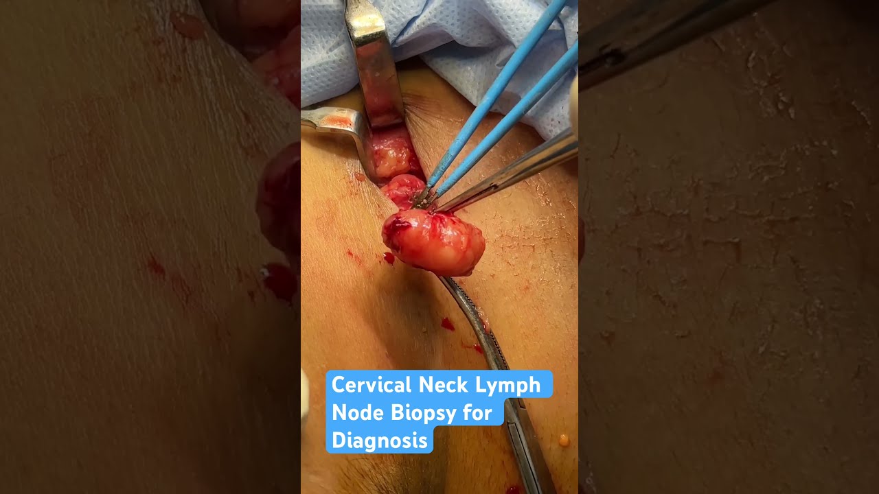 Cervical Lymph Node Biopsy for Suspected Lymphoma Diagnosis #mayomhospital #drmanishprakash