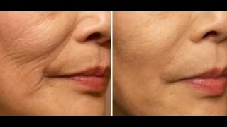 COMBATA RUGAS E BIGODE CHINES COM ESSA PODEROSA RECEITA EFEITO LIFTING!