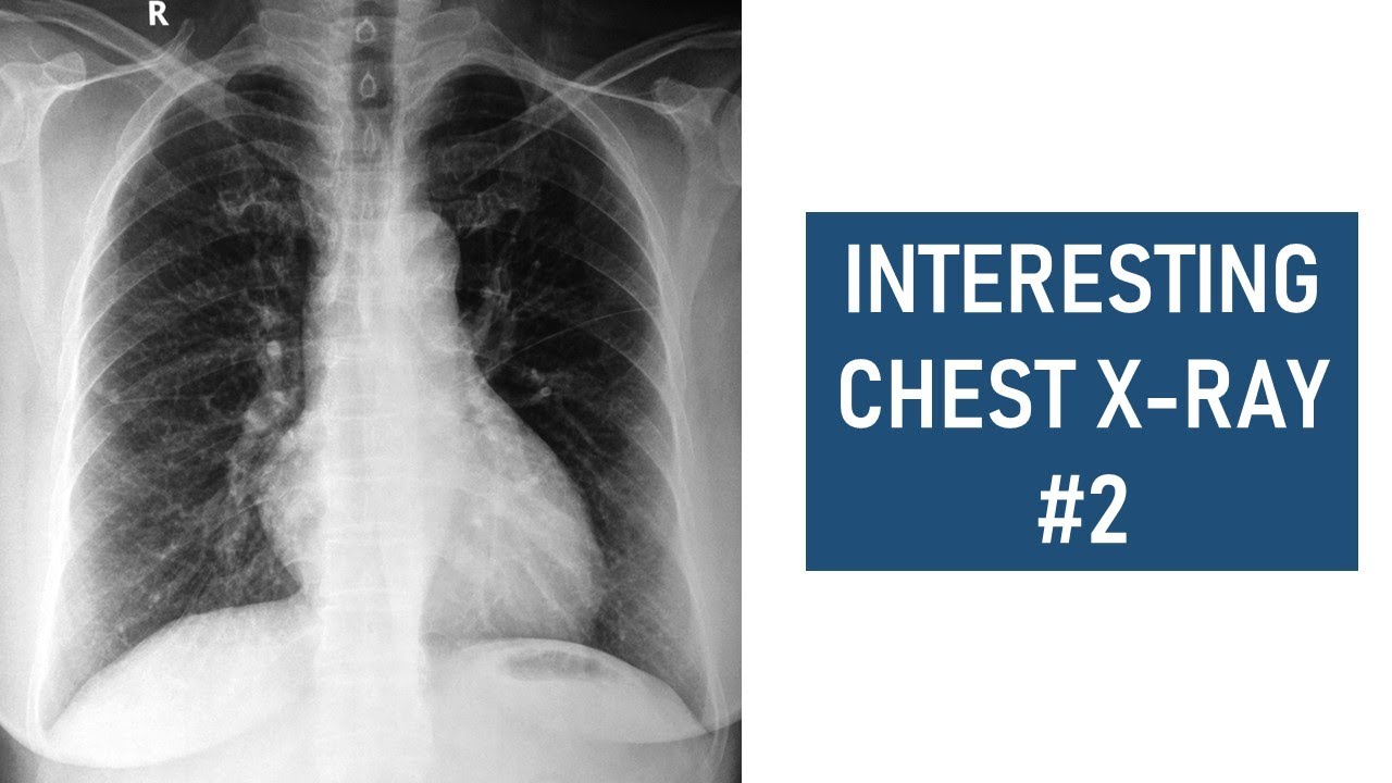 Interesting Chest Xray 2 Accessory Left Horizontal Fissure YouTube