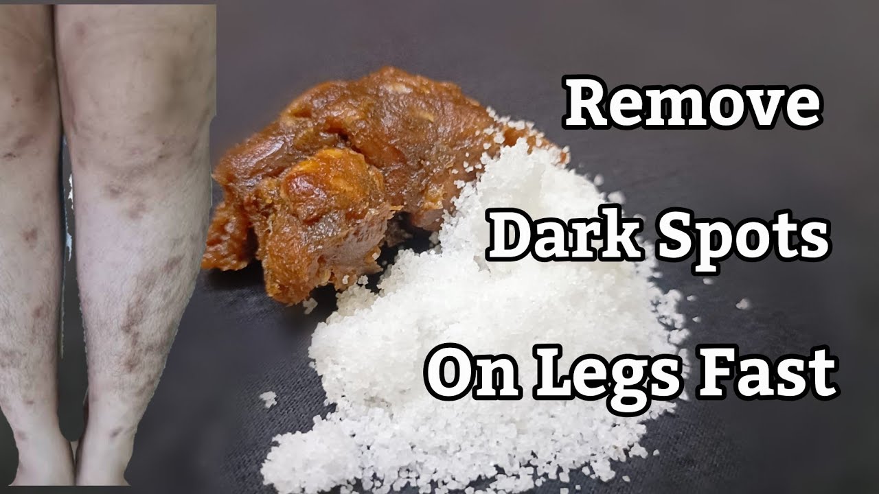 How To Remove Dark Spots On Legs Scar Mosquito Bites, Hyperpigmentation