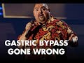 Gastric Bypass Gone Wrong | Gabriel Iglesias