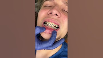 Traditional vs LightForce Braces